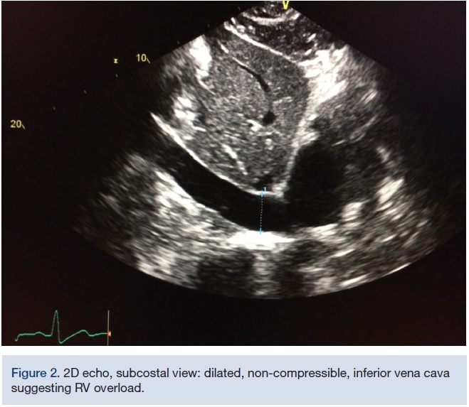 Acute Treatment of a Saddle Embolism With the EKOS Catheter When
